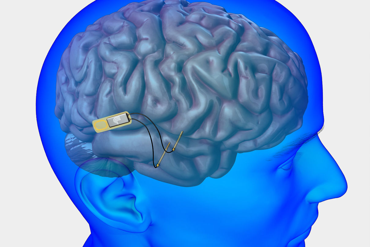Разработан мозговой имплант, который улучшает память на 30%